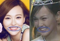 牙医爆料明星整牙视频,牙医亲述整牙全过程